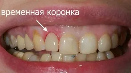 Временни корони на предните зъби и колко снимки можете да носите