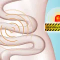 Nyaki Fertőzés - Causes, tünetek és kezelés (méh) Nyaki Infection - okai, tünetei és kezelése