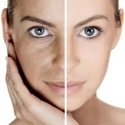 Botox Botox káros az a személy (a következményeket)