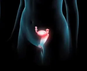 Nyaki Fertőzés - Causes, tünetek és kezelés (méh) Nyaki Infection - okai, tünetei és kezelése