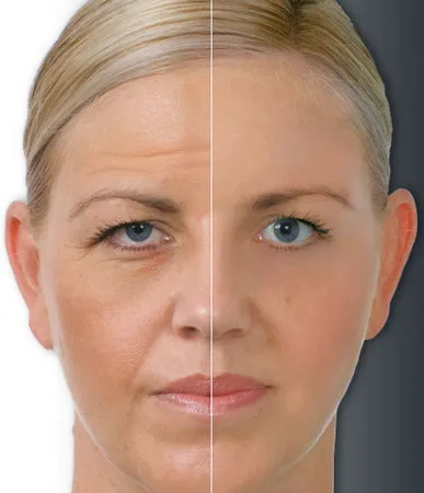 Botox Botox káros az a személy (a következményeket)