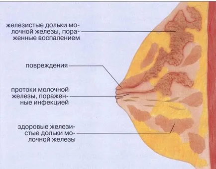 Стагнация на мляко в кърмене - как да се реши този проблем