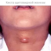 Щитовидната жлеза може да бъде болен