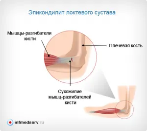 Болка в лакътя, отколкото лечение