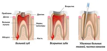 Защото от това, което боли зъб с пълнеж
