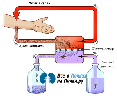 Цената на хемодиализа