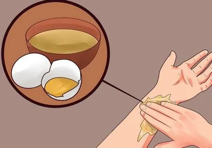 Как за лечение на изгаряния