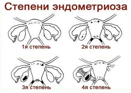 Узи ендометриоза Узи ендометриоза