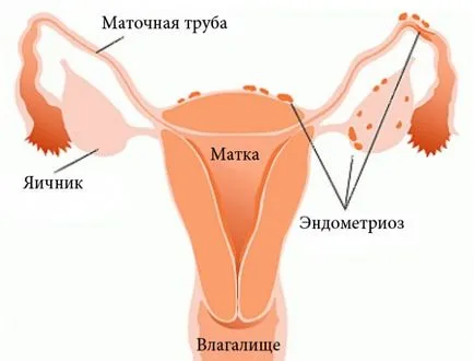 Узи ендометриоза