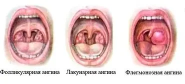 Какво е гнойна ангина