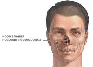 Как да се определи на носната преграда Как да се определи на носната преграда