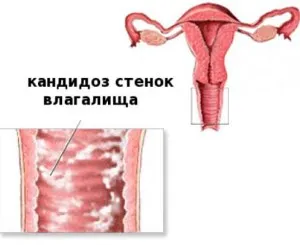 Than за лечение на млечница у дома