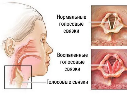 Как да се възстанови след студен глас