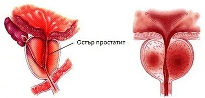 Простатит, който лекува