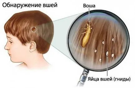 Какво е въшки на детето