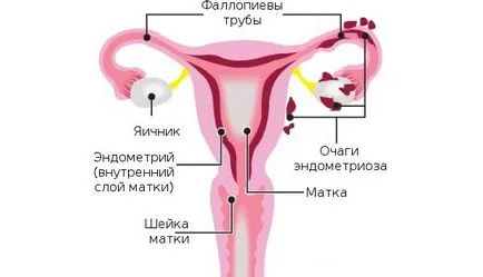 Узи ендометриоза Узи ендометриоза