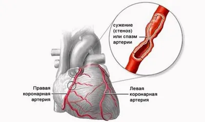 Хронична коронарна недостатъчност какво е Хронична коронарна недостатъчност какво е