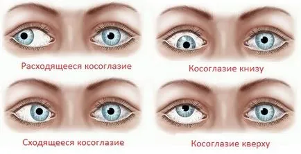 От това, което страбизъм