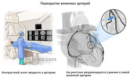 коронарните противопоказания