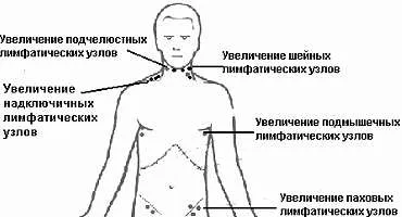 подути лимфни възли се отстраняват