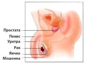 Подуване на тестис, че тя