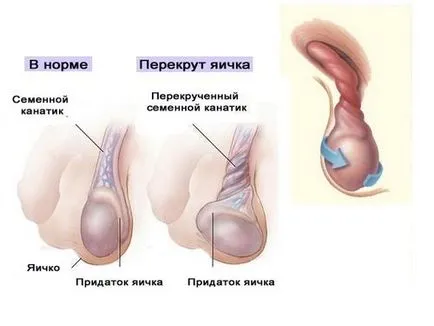 Подуване на тестис, че тя