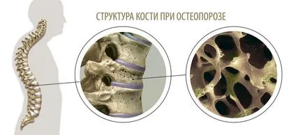 Какво е остеопороза кост