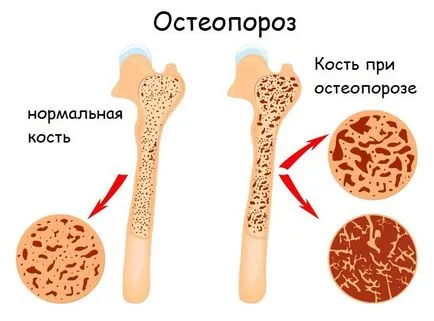 Какво е остеопороза кост
