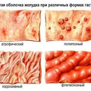 Оригване гнил лечение