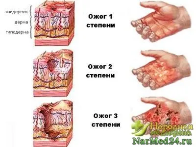 Най-ти изгори