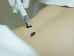 Хемороиди лечение с пиявици