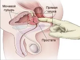 Простатит, който лекува