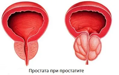 Простатит, който лекува