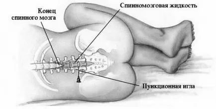 Какво е това, което пункция