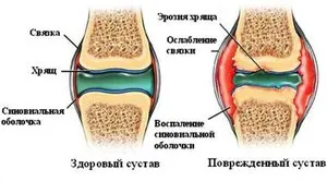 Как да се възстанови на хрущяла