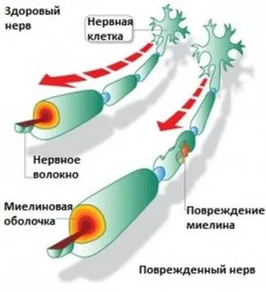 А симптом на множествена склероза А симптом на множествена склероза