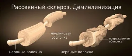 А симптом на множествена склероза