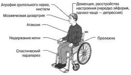 А симптом на множествена склероза