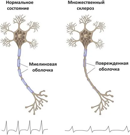 А симптом на множествена склероза А симптом на множествена склероза