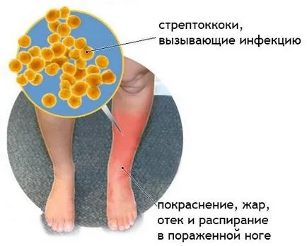 Какво е еризипел възпаление на кожата