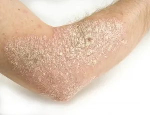 Пилинг лакътя го измерваше