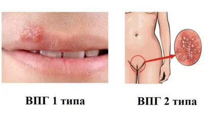 Симптомите на херпес Симптомите на херпес