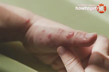 Hogyan lehet megszabadulni a nyomait égések