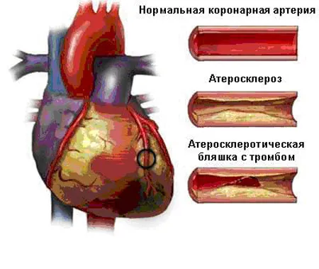 Какво е ангина сърце