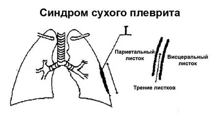 Суха го плеврит