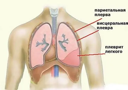 Суха го плеврит