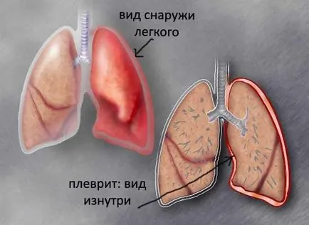 Суха го плеврит