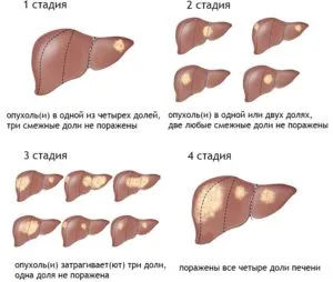 рак в краен стадий