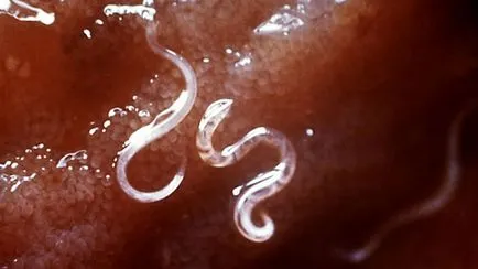 то Trichocephalosis