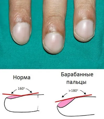 то Trichocephalosis